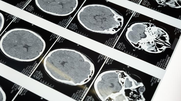 Black and white chart of brain scans